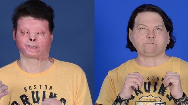 press-release-first-successful-face-and-double-hand-transplant.jpg 