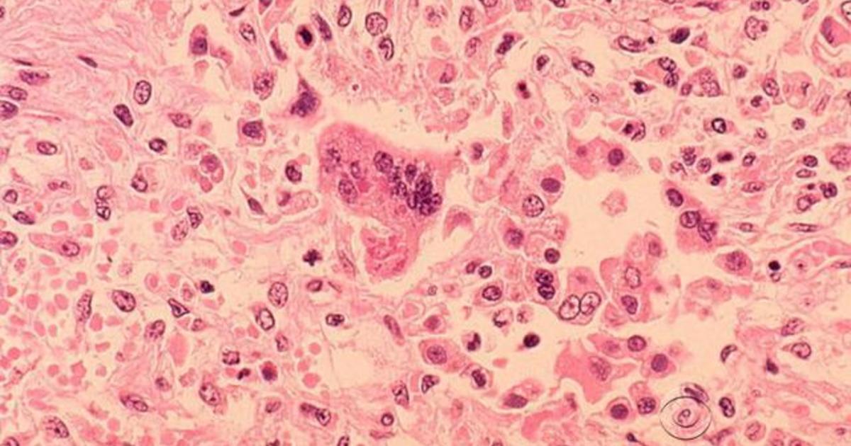 State health department warns that siblings with measles may have exposed others at HCMC