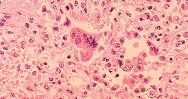 Measles confirmed in 3 unvaccinated Twin Cities children, health department says