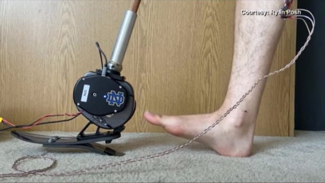 prostheticlimbsthatuseAI.jpg 