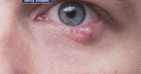 Could MaskUse Be Causing Some People To Get Styes? CBS Texas