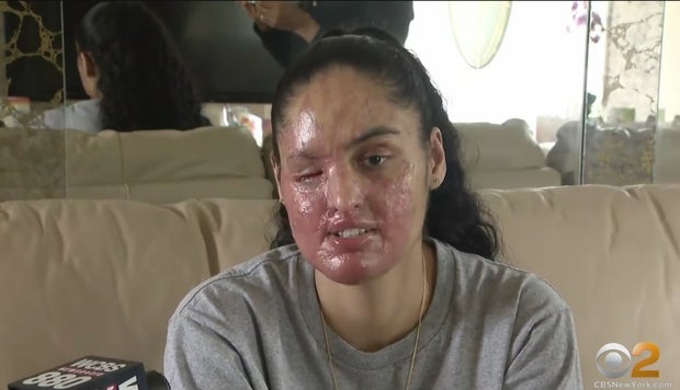 Acid-Attack-victim.jpg 