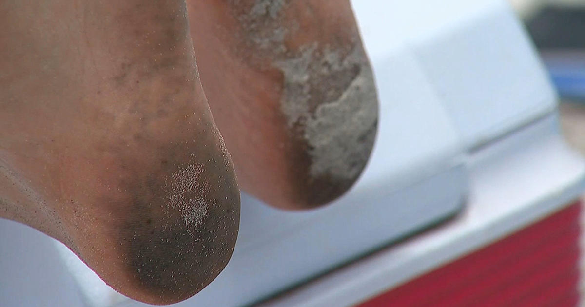 maine-beachgoers-feet-turning-black-after-day-at-the-ocean-experts