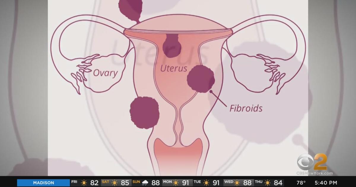 New Medical Options For Uterine Fibroids Include Radio Frequency Ablation New Drugs CBS New York