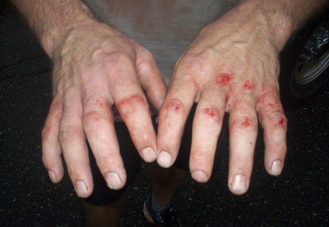 Todd Kendhammer's injured hands