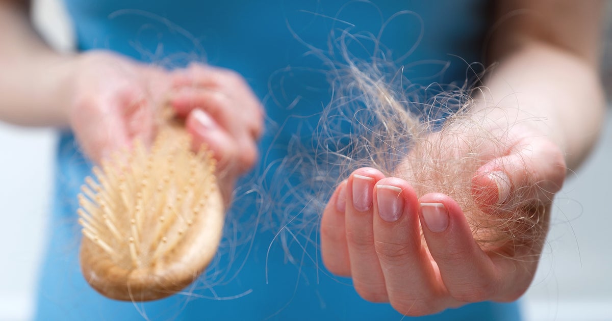 Most Postmenopausal Women Will Experience Hair Loss, Study Suggests