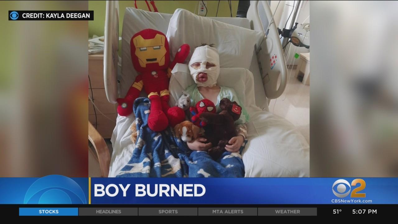 Yankees host Bridgeport boy burned by gasoline