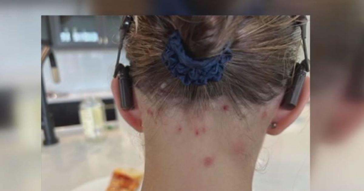 Parents Concerned About Bug Bites Found On Children All Over 