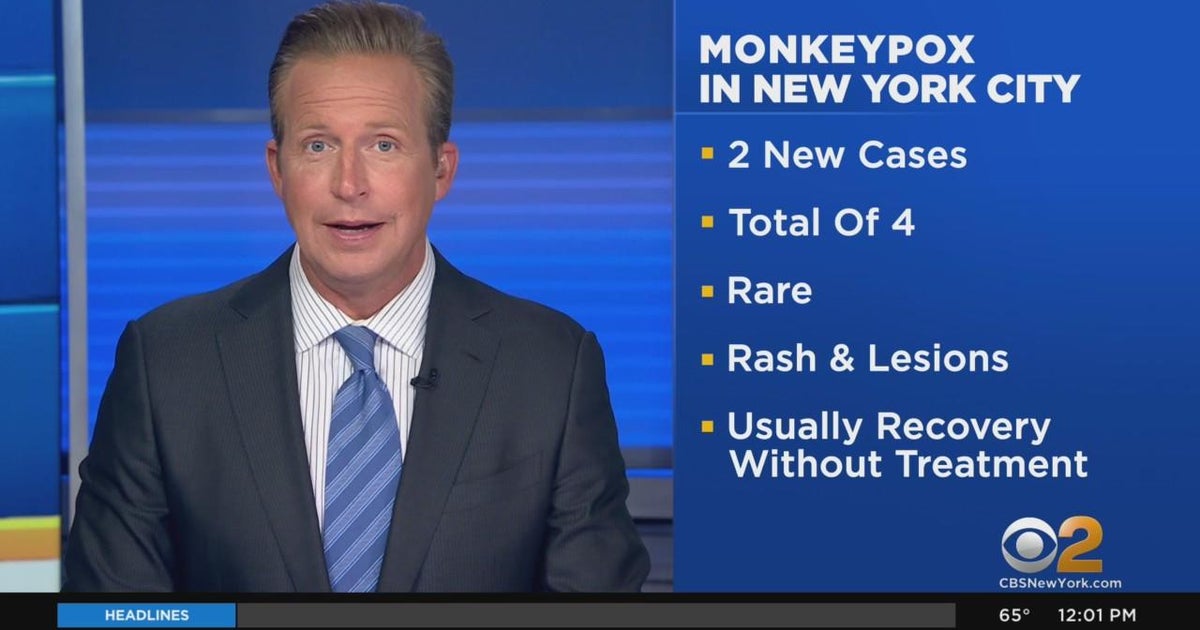 2 more cases of monkeypox suspected in NYC CBS New York