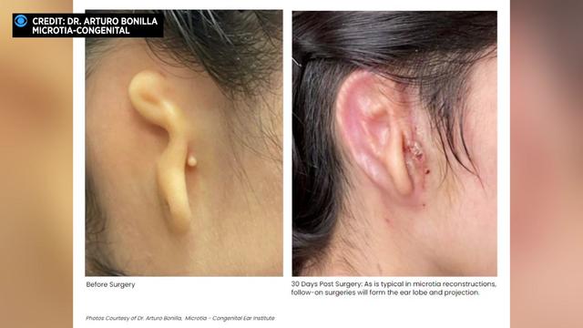 Woman in Mexico undergoes groundbreaking surgery using 3D-printed ear made of human cells 