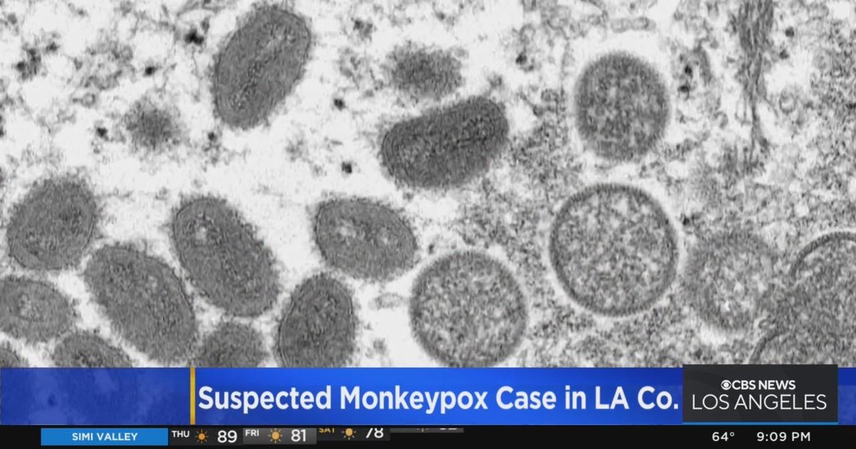 Suspected case of monkeypox in LA County - CBS Los Angeles