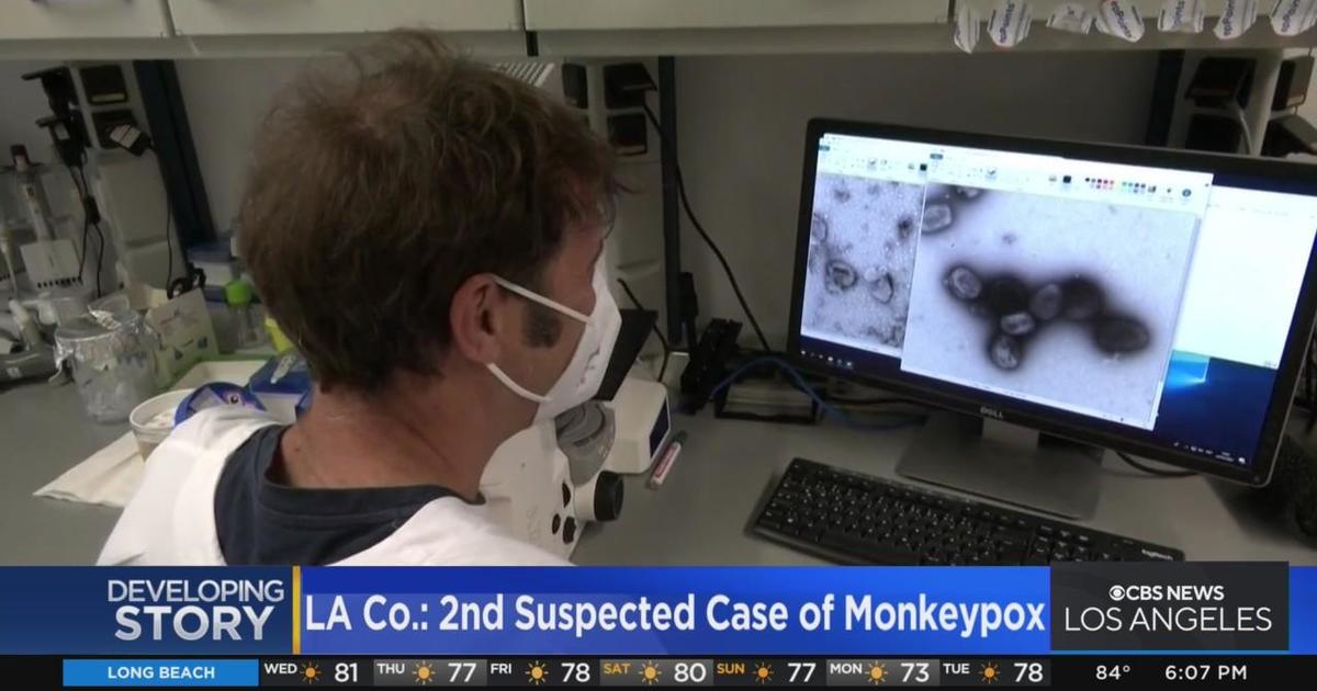 LA County reports second presumed case of monkeypox CBS Los Angeles