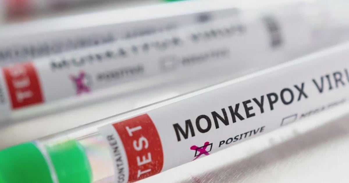 First monkeypox case found in Pittsburgh