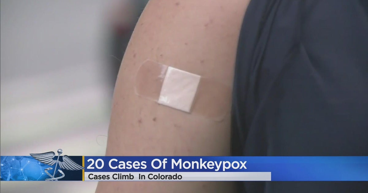 Monkeypox cases climb to 20 in Colorado - CBS Colorado