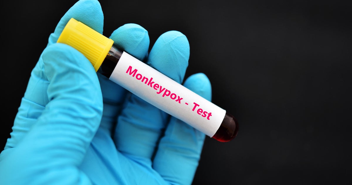 1st confirmed case of monkeypox identified in Solano County - CBS ...