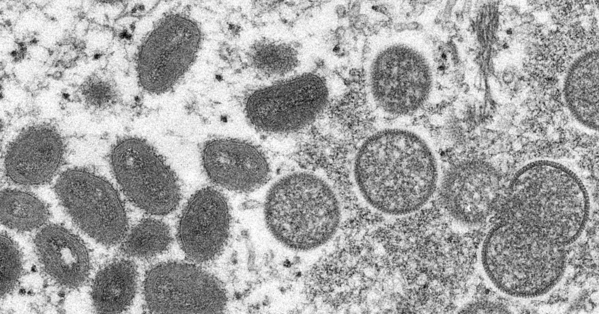 U.S. confirms first two cases of monkeypox in children