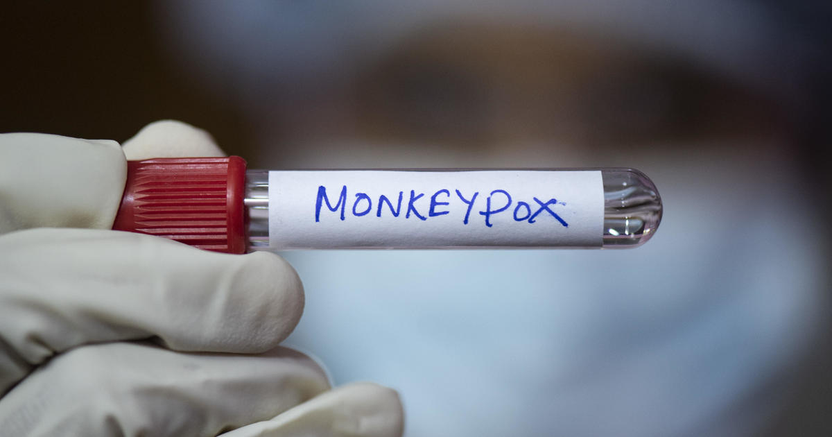 Free monkeypox vaccine clinic offered at Sacramento LBGT Community Center