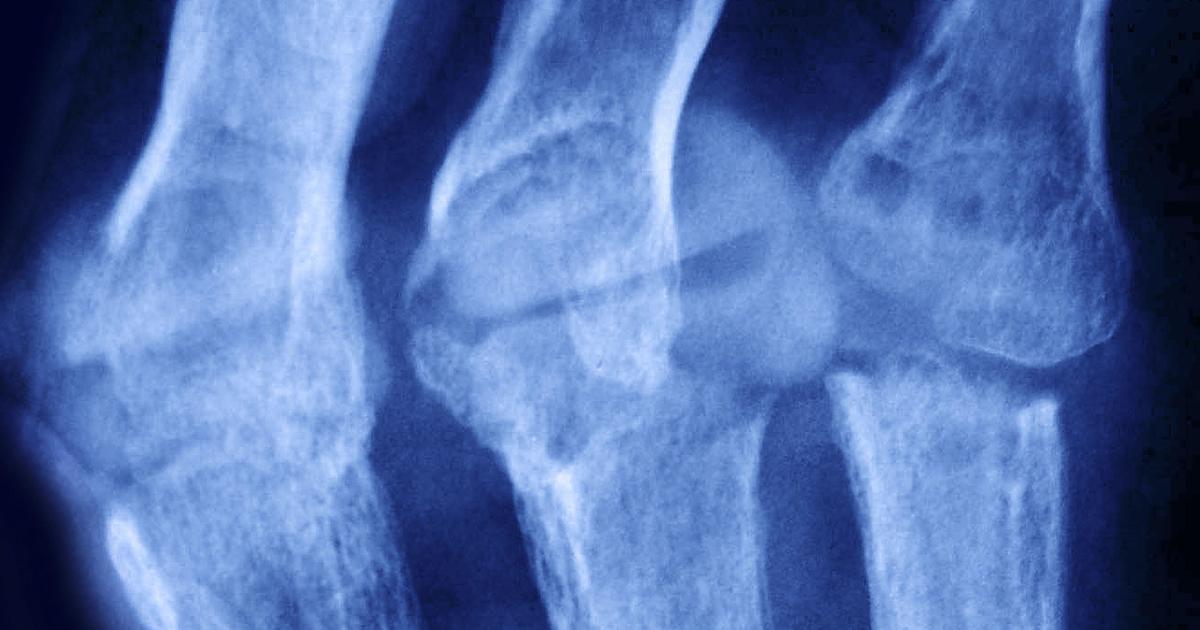 Rheumatoid arthritis isn't your grandmother's arthritis