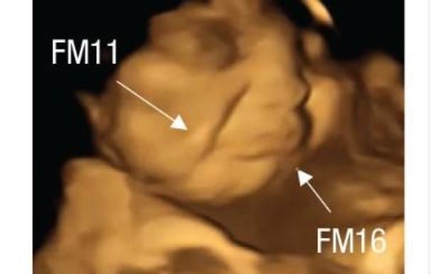 Fetus whose mother had just eaten kale is seen apparently frowning. FM11 is described as nasolabial furrow and FM12 as lower-lip depressor.