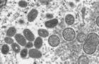 CDC microscopic image shows monkeypox virus particles 