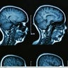 cbsn-fusion-study-new-alzheimers-drug-slows-progression-of-disease-thumbnail-1508611-640x360.jpg 