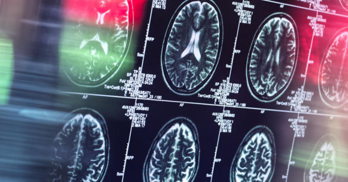 Study: Teens’ brains aged faster during the pandemic
