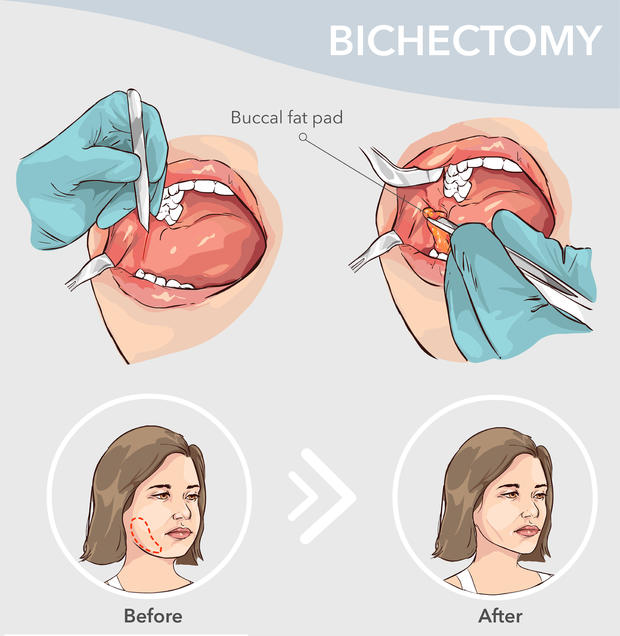 Buccal Fat Pad Removal  Before and after vector illustration 