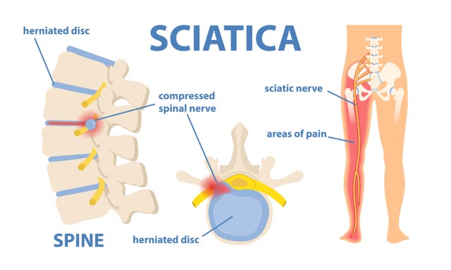 Sciatic nerve pain 