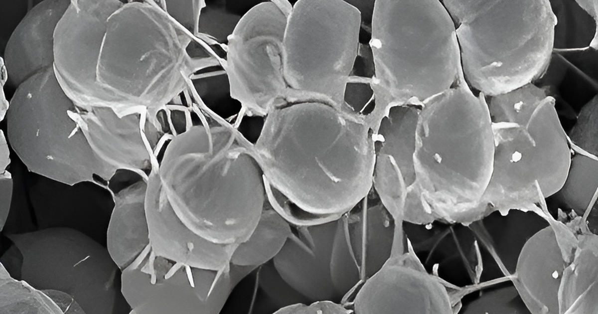 US investigating first cases of “concerning” new drug-resistant gonorrhea strain