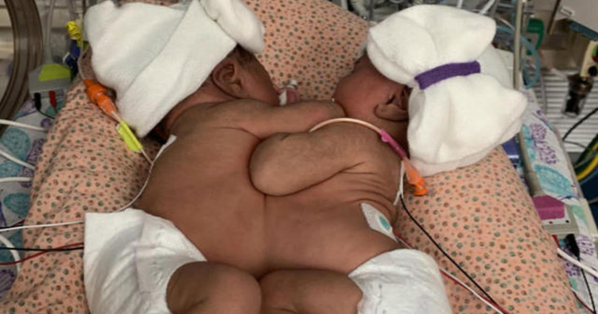 Conjoined twins separated by Texas doctors after 