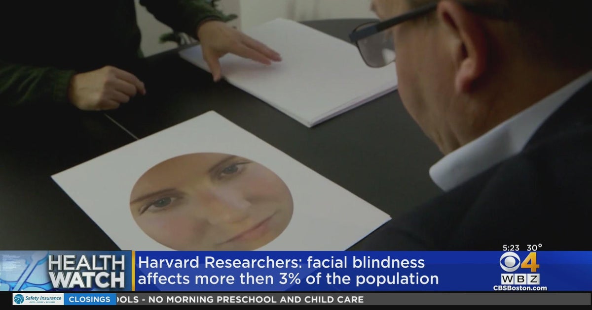 Facial blindness affects more than 3% of population, Harvard study ...