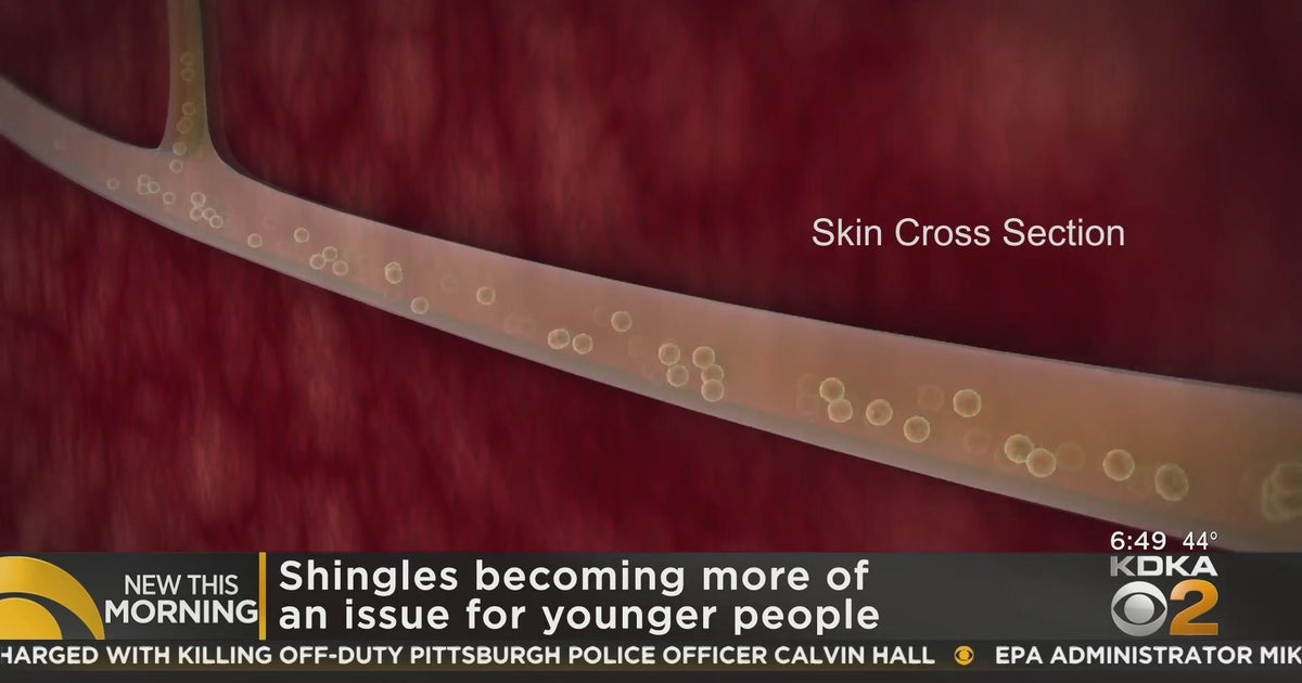 Shingles cases on the rise in younger patients CBS Pittsburgh