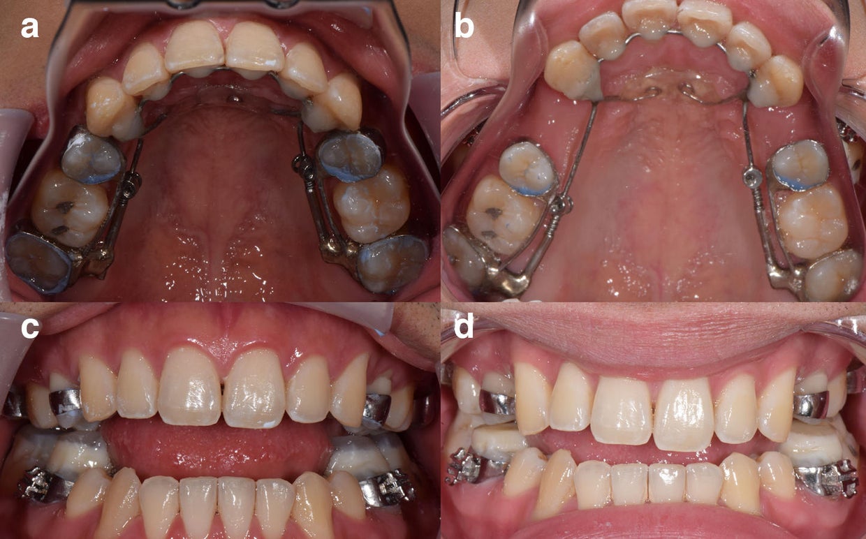 Before and after photos of a dental patient's teeth
