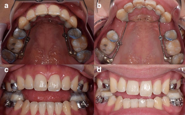 Before and after photos of a dental patient's teeth