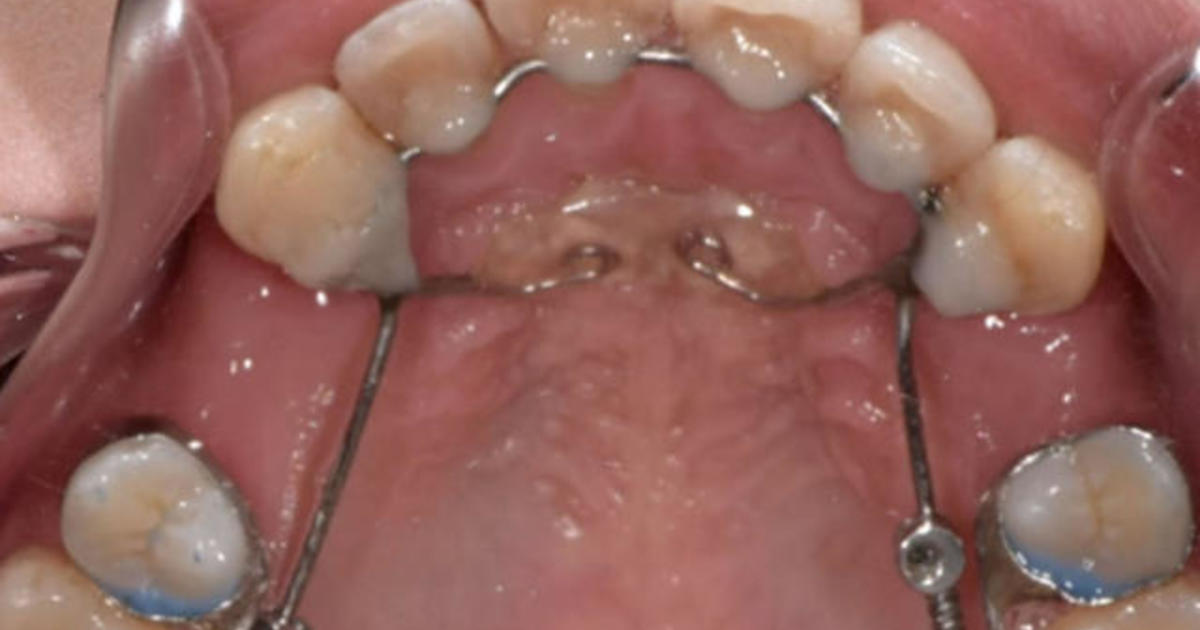 Lawsuit claims dental device damaged patients’ teeth