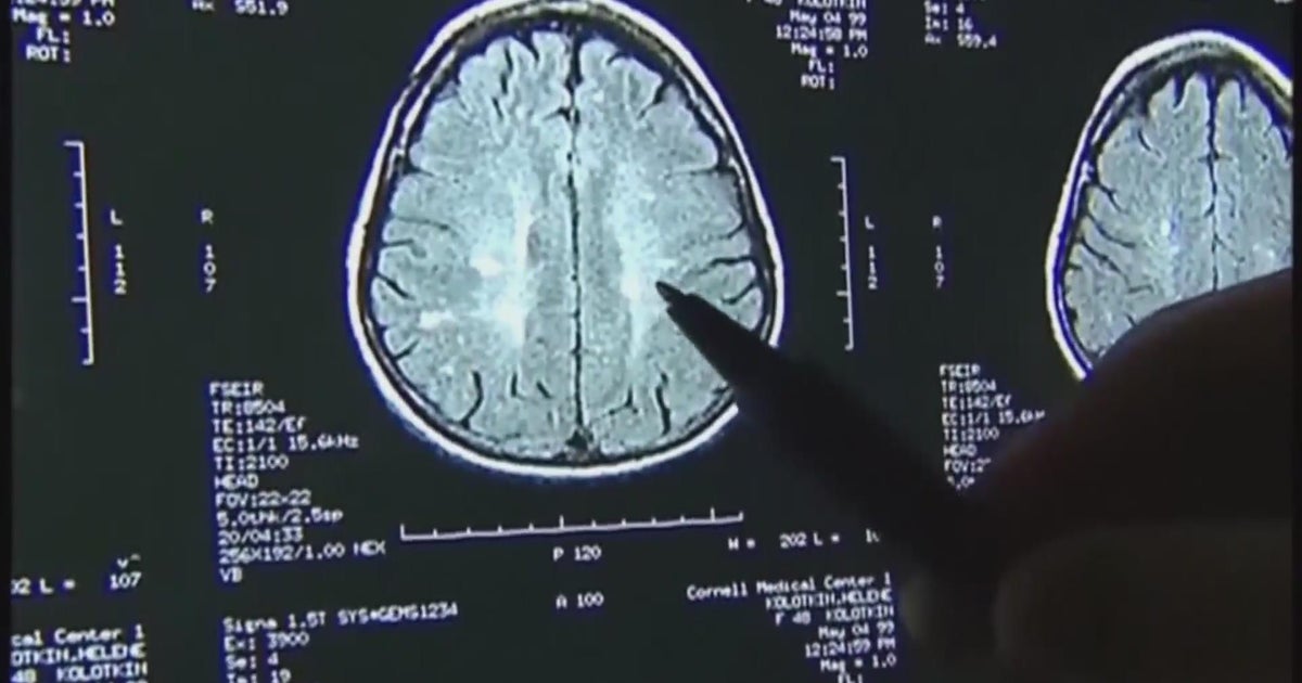 New blood test helps evaluate brain injuries - CBS Texas