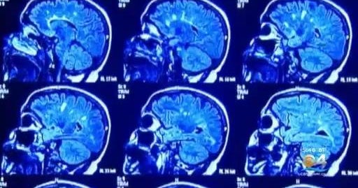 Food and drug administration approves new nasal spray to handle migraine complications in grown ups, Pfizer suggests