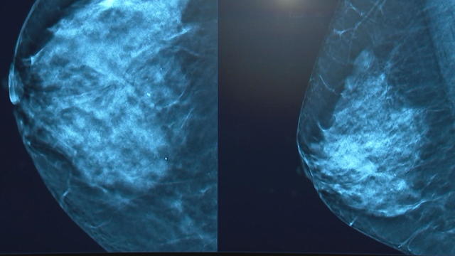 16pkg-ss-3d-mammography-frame-207.jpg 