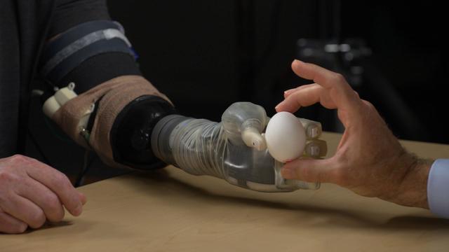 Advancements in prosthetics limb technology allow feeling, control