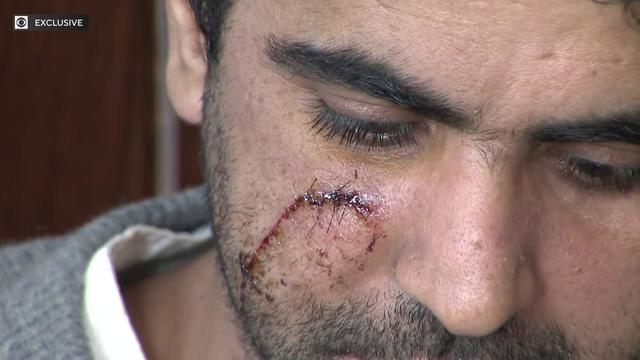 A close-up of a scar on a gas station worker's face. 