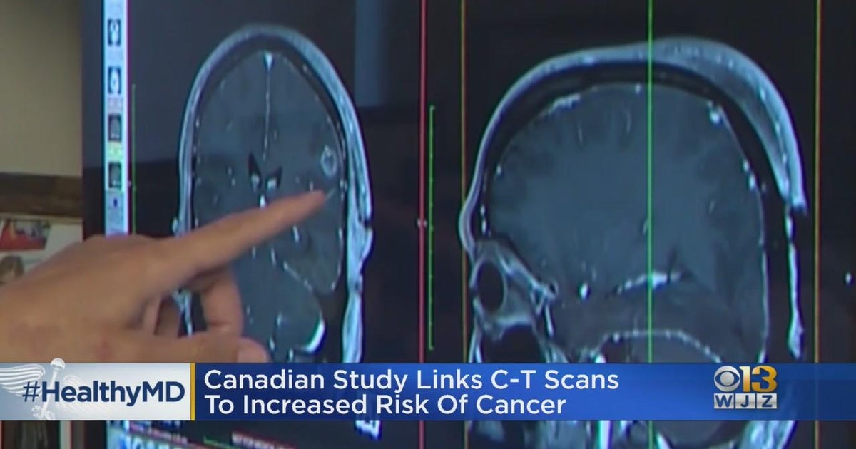 Healthwatch: Study links CT scans to increased risk of cancer - CBS ...