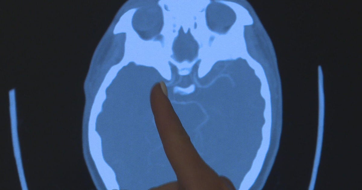 Stroke rates among young adults "nearly doubled" in northern Colorado in recent years - Vimarsana News