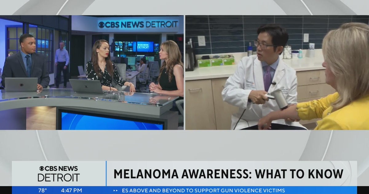Melanoma awareness: What to know and what to look for - CBS Detroit