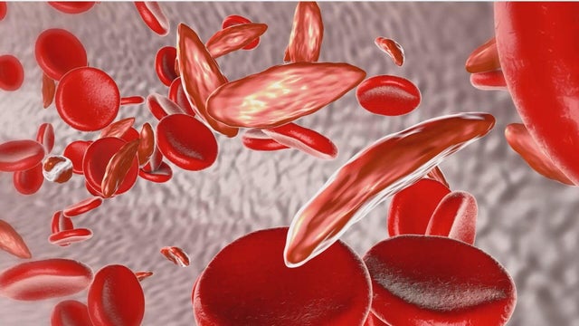 World's first gene therapy for sickle cell and thalassemia approved in the U.K.
