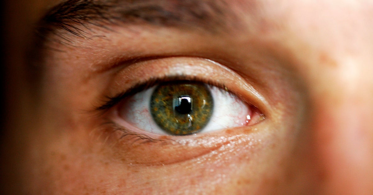 Probiotic supplement could help alleviate dry eye researchers say