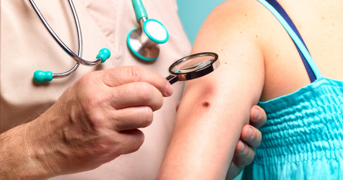 Does health insurance cover skin cancer screening Dr Mallika Marshall answers your questions Does health insurance cover skin cancer screening Dr Mallika Marshall answers your questions