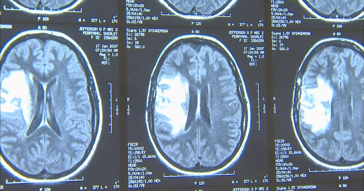 Baltimore City among areas with highest Alzheimer's prevalence in U.S. - Vimarsana News