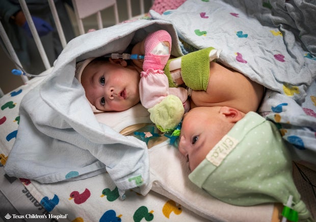 2k23-0361-fg-7936-conjoined-twins-surgery-copy.jpg