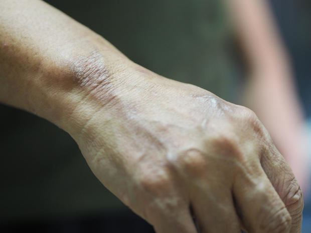 Leprosy could be endemic in Central Florida, CDC says. What to know about the disease. - CBS News