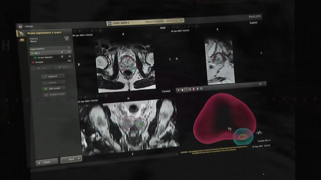Images on a computer screen show medical scans of a patient with prostate cancer. 